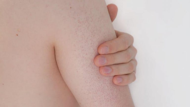 Vücutta kırmızı lekeler mi? Vücuttaki kırmızı lekeler puanları nasıl geçiyor?