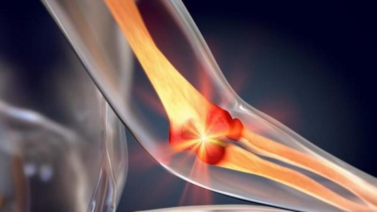 Kalsiyumunuz eksikse bu hastalıklara yakalanabilirsiniz! Kalsiyum Eksikliğinde Görülen Hastalıklar Nelerdir? Kalsiyum Eksikliği Hangi Hastalıklara Neden Olur?