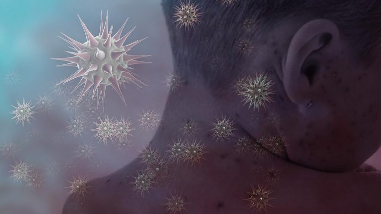 Endonezya’da kızamık salgınında 17 kişi hayatını kaybetti