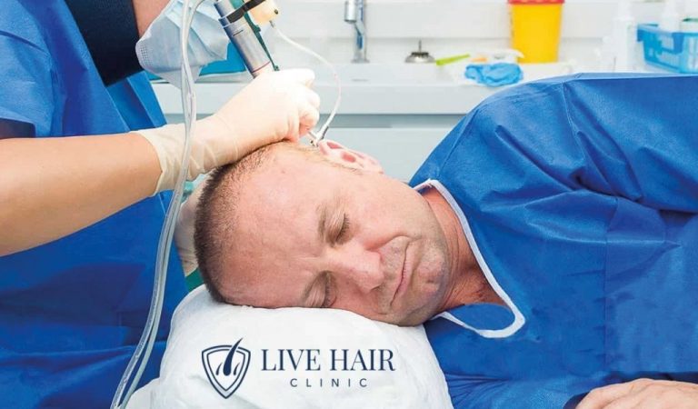 İstanbul Saç Ekimi ile Doğal ve Kalıcı Sonuçlar